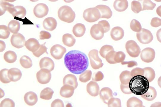 BCP-22 Blood Cell Identification Graded Platelet, normal 72 98.6 5204 98.4 Good Platelet, hypogranular 1 1.4 64 1.
