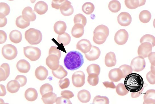 BCP-24 Blood Cell Identification Graded Lymphocyte 72 98.6 5256 99.4 Good Lymphocyte, large granular 1 1.4 4 0.