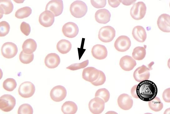 BCP-25 Blood Cell Identification Graded Sickle cell (drepanocyte) 70 97.2 5087 96.2 Good Fragmented red cell 1 1.4 124 2.