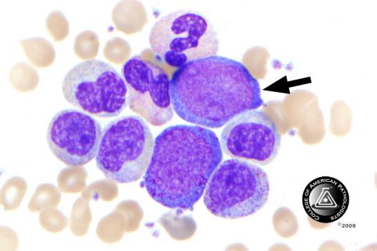 BCP-26 Blood Cell Identification Ungraded Case History The patient is a 24-year-old female presenting with a 3 week history of progressive abdominal distention, secondary to massive splenomegaly.
