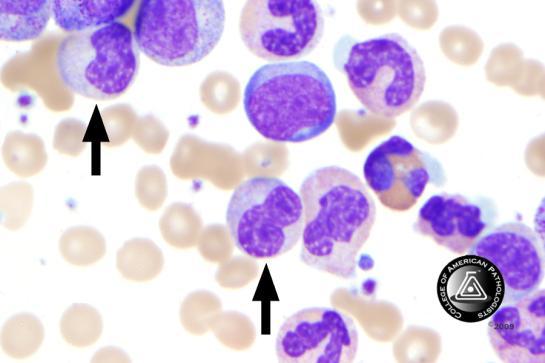BCP-28 Blood Cell Identification Ungraded Neutrophil, metamyelocyte 62 87.3 4469 87.1 Educational Neutrophil, segmented or 4 5.6 93 1.8 Educational band Monocyte 4 5.6 255 5.