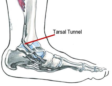 Anatomy Involved The ankle is formed by the tibia, fibula and talus. The medial malleolus of the tibia and the flexor retinaculum form the walls of the Tarsal Tunnel.