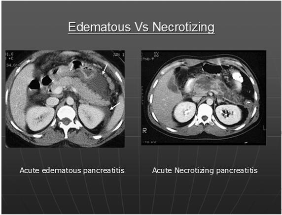 The above clinical classification recognizes the importance of pancreatic necrosis, but overlooks intermediary forms of disease with fluid collections. Bradley.E.