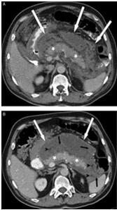 contrast and/or Peripancreatic necrosis Acute peripancreatic fluid collection: Peripancreatic fluid occurring in the setting of interstitial edematous pancreatitis; this peripancreatic fluid occurs
