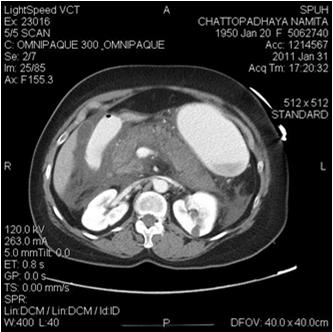 Several tests can help differentiate biliary pancreatitis from other causes of AP. Specificity of ALT > 150 IU/L for gallstone AP is 96%.