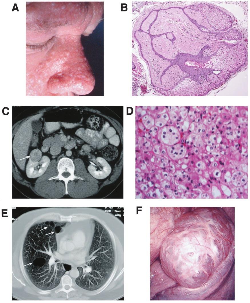 396 Risk of Malignancy in Fig. 2. Clinical manifestations of.