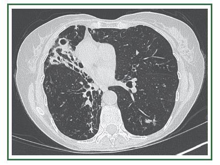 NTM Pulmonary Infections Symptoms and Pathology Chronic cough Breathlessness Hemoptysis Reduced lung function Potential respiratory failure Bronchiectasis