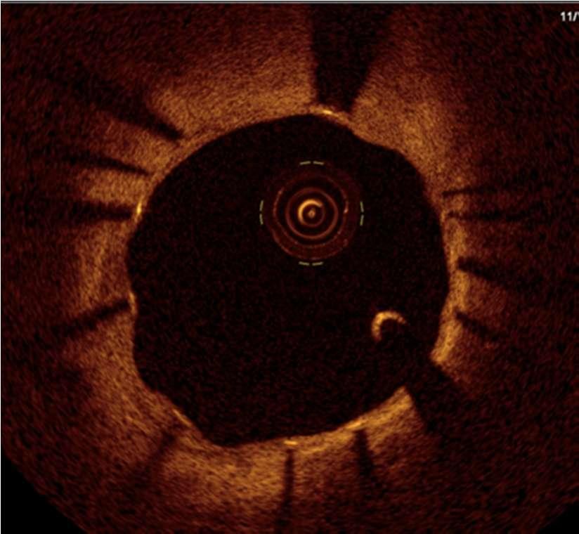 Coherence Tomography -