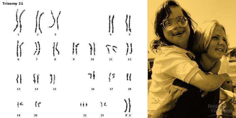 One aneuploid condition, Down syndrome, is due to three copies of chromosome 21. It affects one in 700 children born in the U.S.