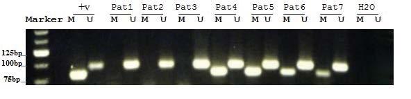 The use of TMZ in GBM induces alkalization into DNA to prevent its replication that causes cell death.