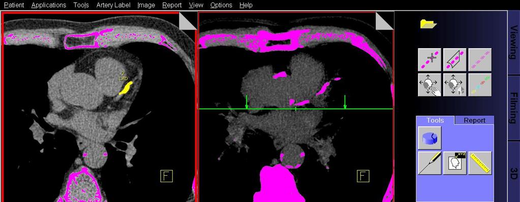 Introduction Figure 1-4. Non-enhanced cardiac CT dataset with at the top right marked calcified plaques in the traject of the left anterior descending artery.