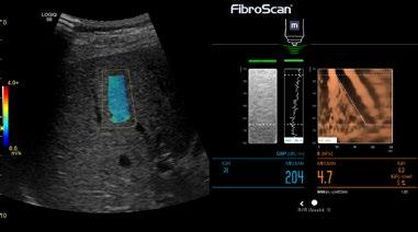 Contrast Enhanced Imaging (CEUS) Optimized contrast agent specific waveforms to enhance the clinician s ability to detect and characterize lesions including advanced