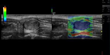 2D Shear Wave Elastography Provides quantitative measures of tissue elasticity and color-coded elastograms to assist clinicians in diagnostic and patient management
