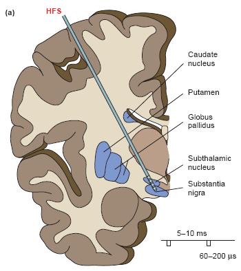Deep brain stimulation in PD