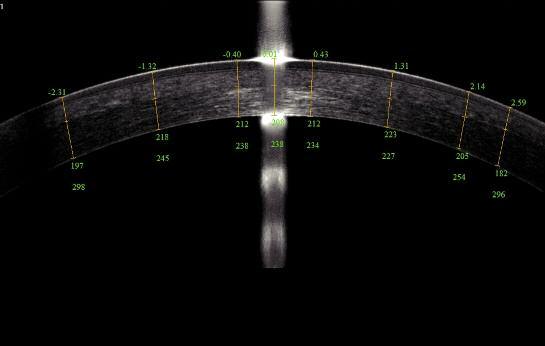 Routine OCT and UBM of the anterior segment UBM instruments Very high frequency ultrasonography applied to the anterior segment was described in the 1990s by Charles Pavlin, with the first