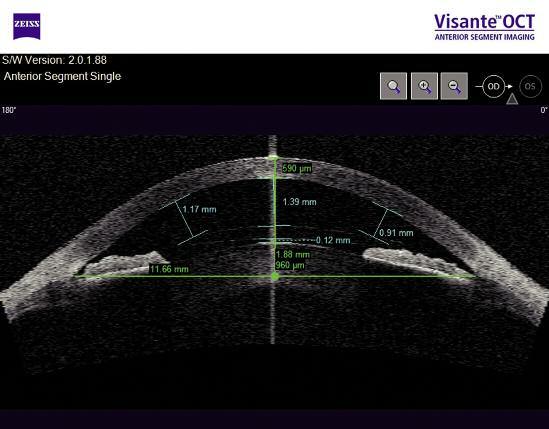 The principle of these instruments is to use very high-frequency ultrasonographic probes (higher than 20 MHz) with focusing between 10 and 12 mm so as to obtain better resolution on the anterior