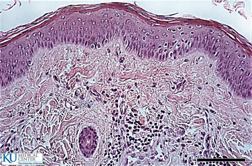 DENSE CT 2. DICT :composed of mainly collagen fibers in irregular arrangement (non-living significance?