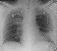 Chest radiograph obtained 5 days after admission reveals progression of consolidation and decreased lung volumes.