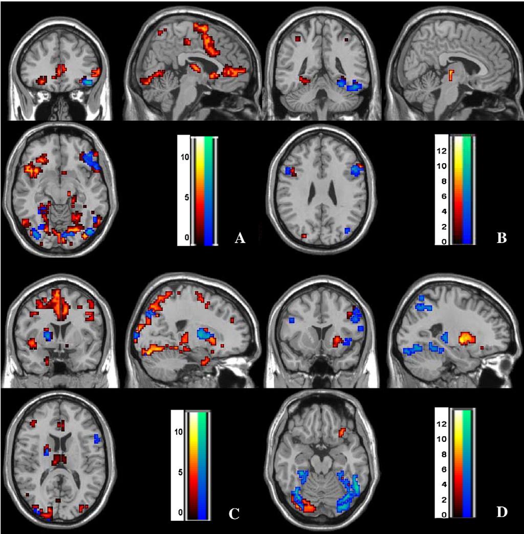 B. Schiffer et al. / NeuroImage 41 (2008) 80 91 87 Fig. 2. Regional maps of activation in heterosexual controls and paedophiles for the Sexual Block Neutral Block contrast in various conditions.