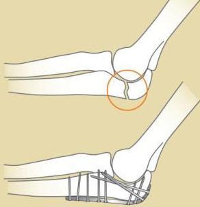 EARLY MOTION PROTOCOL 1-3 DAYS POST OP OLECRANON FRACTURES Anatomy of the elbow Open reduction internal fixation Post-Operative Course a. Splints b.