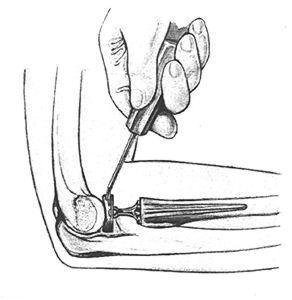 The joint allows you to flex (bend) and extend (straighten) your arm. The total amount of movement that the elbow can produce is approximately 145 degrees.