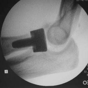 While this treatment usually permits early motions of the elbow, attention to the therapy program is essential to achieve optimal result from your surgery.