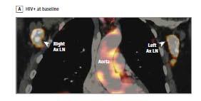 Representative coronal images of HIV infected subject demonstrating decreased lymph node inflammation and increased aortic