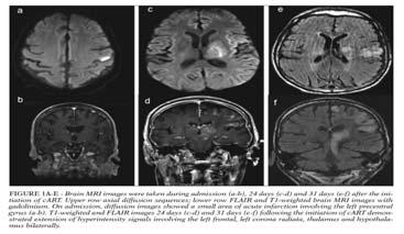 Admission: stroke HIV-associated CNS IRIS 24 days post-art: IRIS 31 days post-art: IRIS Slide 19 23 of 34 57 yo HIV+ man, off ART x 3 years, then re-start: 3 weeks right