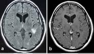 (2013) HIV-associated CNS IRIS in PML patient Slide 20 24 of 34 Before ART 52 yo HIV+ man, ART naïve x 16 years, admitted for sub-acute cognitive decline cart started: CD4 T