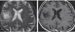 Later neurological complications of HIV infection: Progressive Multifocal Leukoencephalopathy (PML) typical