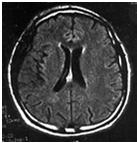 Later neurological complications of HIV infection: HIV-associated neurocognitive disorders (HAND) 1/3 have MRI evidence of white matter abnormality, with or without brain atrophy Slide 28 of 34