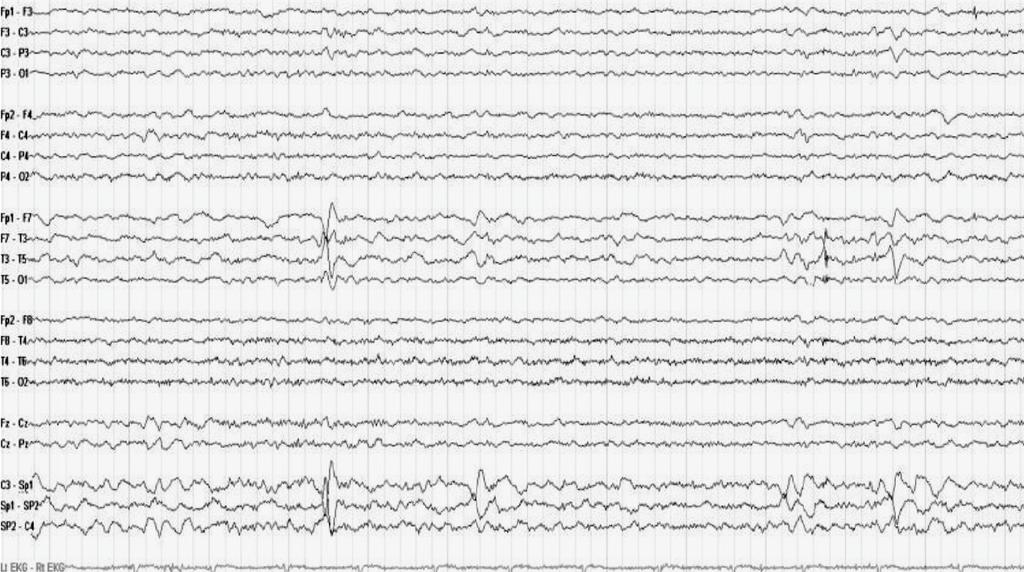 Figure 4 EEG showed Right focal spike for patient presented by generalized tonic clonic seizure (Idiopathic) with normal MRI brain, MRA and MRV.