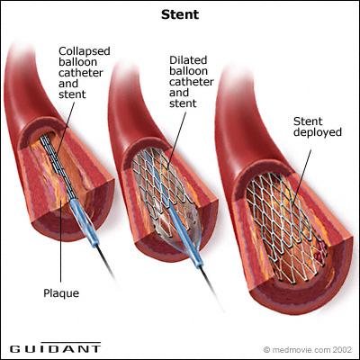 Innovative solution to the problem of the drugcoated stents Drug-coated stent prevents restenosis -- a re-narrowing of the artery around the stent due to the post-procedural trauma.