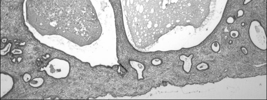 Histology of the biopsy: cystically dilated glands
