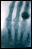 X-Ray examples The first acquisition Current medical applications: X-Ray images removed due to copyright