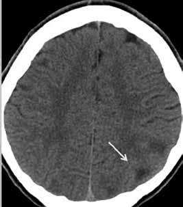 () Axil CT scns of single skull in ptient with