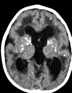 sclerosis: suependyml nodules nd clcified prenchyml