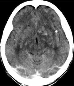 with HIV. Figure 9. Simple crnil CT in ptients dignosed with Fhr s disese: ilterl symmetricl clcifictions of the sl gngli.