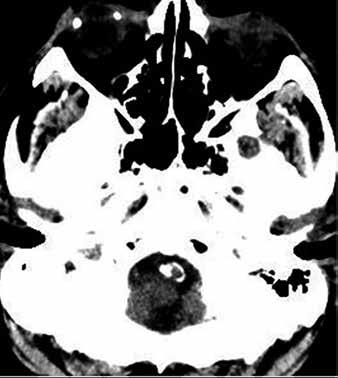 clcifictions. Figure 13. Axil CT scn of single skull.