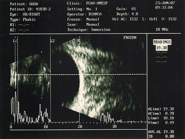 Simultaneous mode A and mode B The first study regarding echobiometry of cataractous lens in dogs was conducted by Williams (2004), using mode B ultrasonography. Williams reported 6.4mm, 7.4mm, and 8.