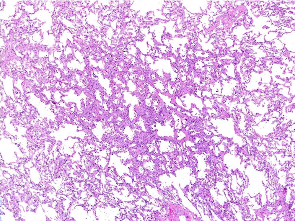 Let s start with atypical adenomatous hyperplasia.