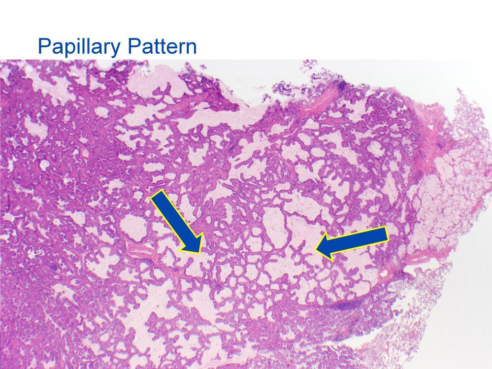 Papillary patterns are comprised of papillae, which have fibrovascular cores that are lined by neoplastic cells.