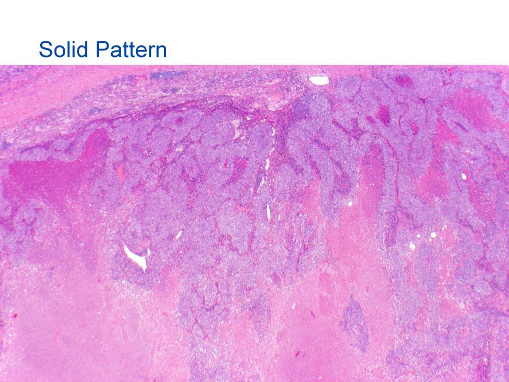 A solid pattern of adenocarcinoma can be difficult to distinguish from a solid pattern