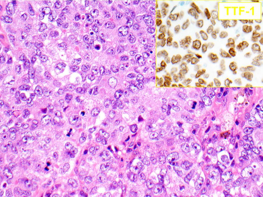 In this case, the neoplastic cells were positive for