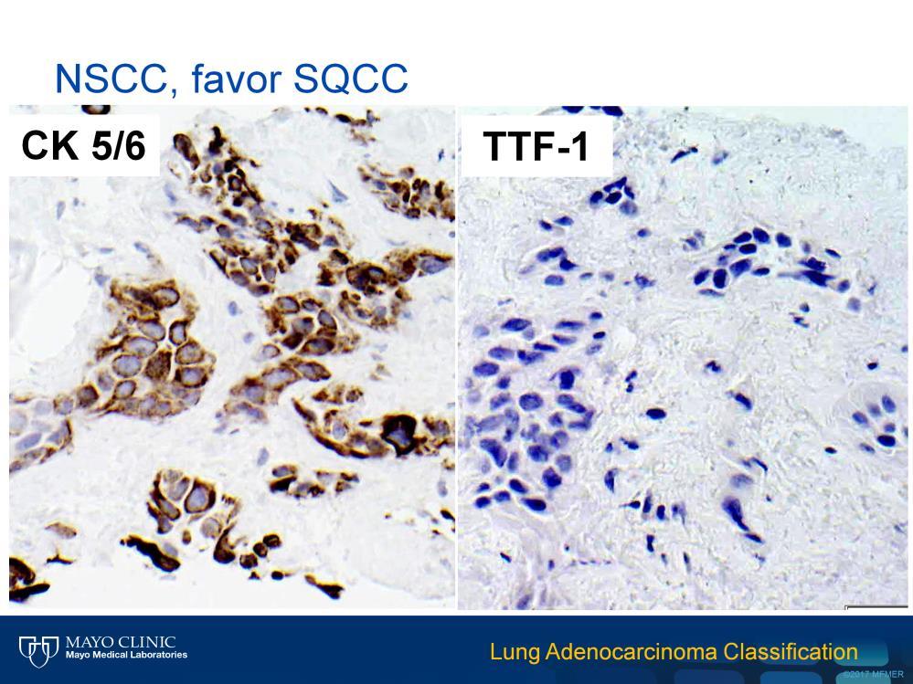 which show that the neoplastic cells are positive for CK5/6 and negative for TTF-1.