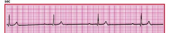 Heart rate disturbances Low heart ratelow number of SVlow