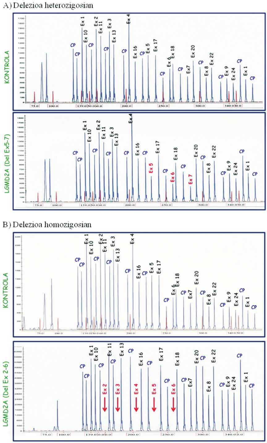 Oihane Jaka 1. irudia. Delezio heterozigoto eta homozigoto baten MLPA profilak. A, 2. gaixoaren kasua: 5., 6. eta 7. exoien delezioa du heterozigosian (kontrolarekiko dosi erdia, gorriz). B, 3.