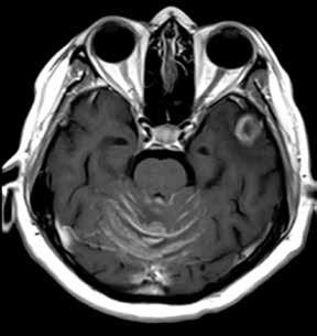 leptomeningel crcinomtosis. MRI with T1 informtion.