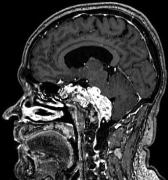 L-sprginse-induced reversile posterior leukoencephlopthy syndrome. MRI ) Axil FLAIR: Lesions with high signl of periventriculr white mtter. ) With T1 informtion with contrst medium.