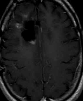 astrocytoma, now with new